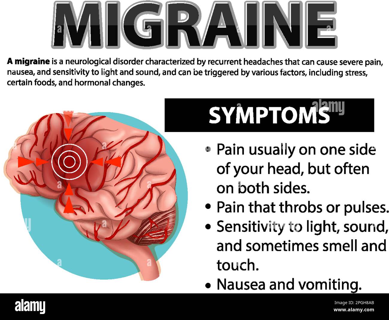 Informative poster of Migraine illustration Stock Vector Image & Art ...