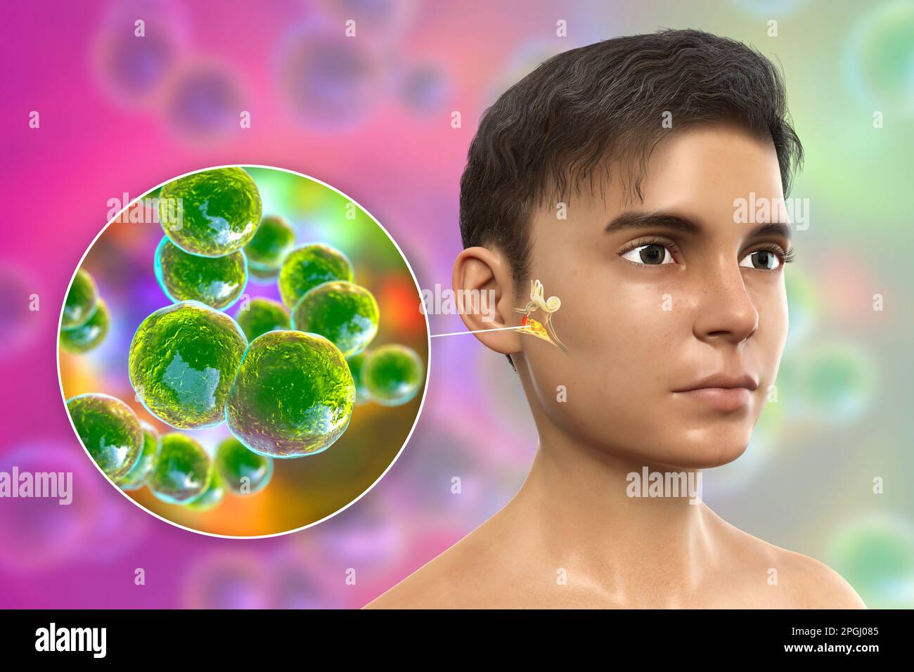Otitis media ear infection caused by Moraxella catarrhalis bacteria