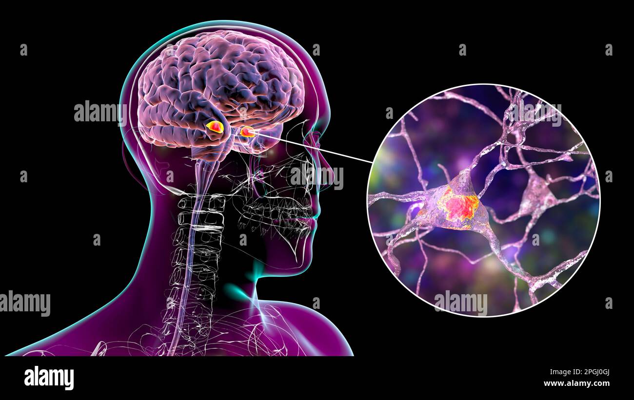 Amygdala in the brain, and closeup view of amygdala neurons, computer