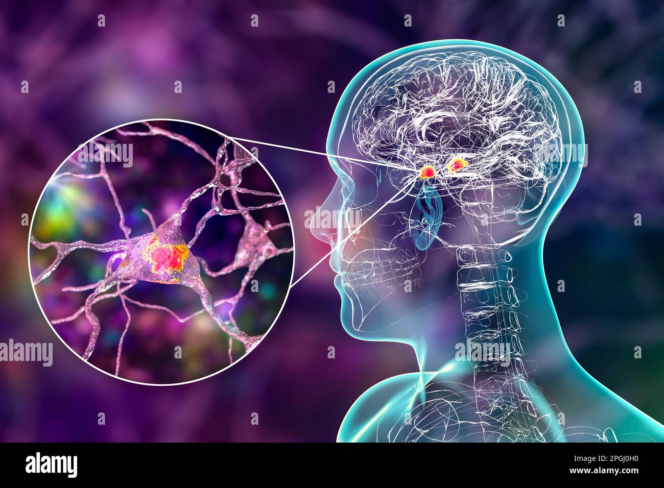 Amygdala in the brain, and closeup view of amygdala neurons, computer