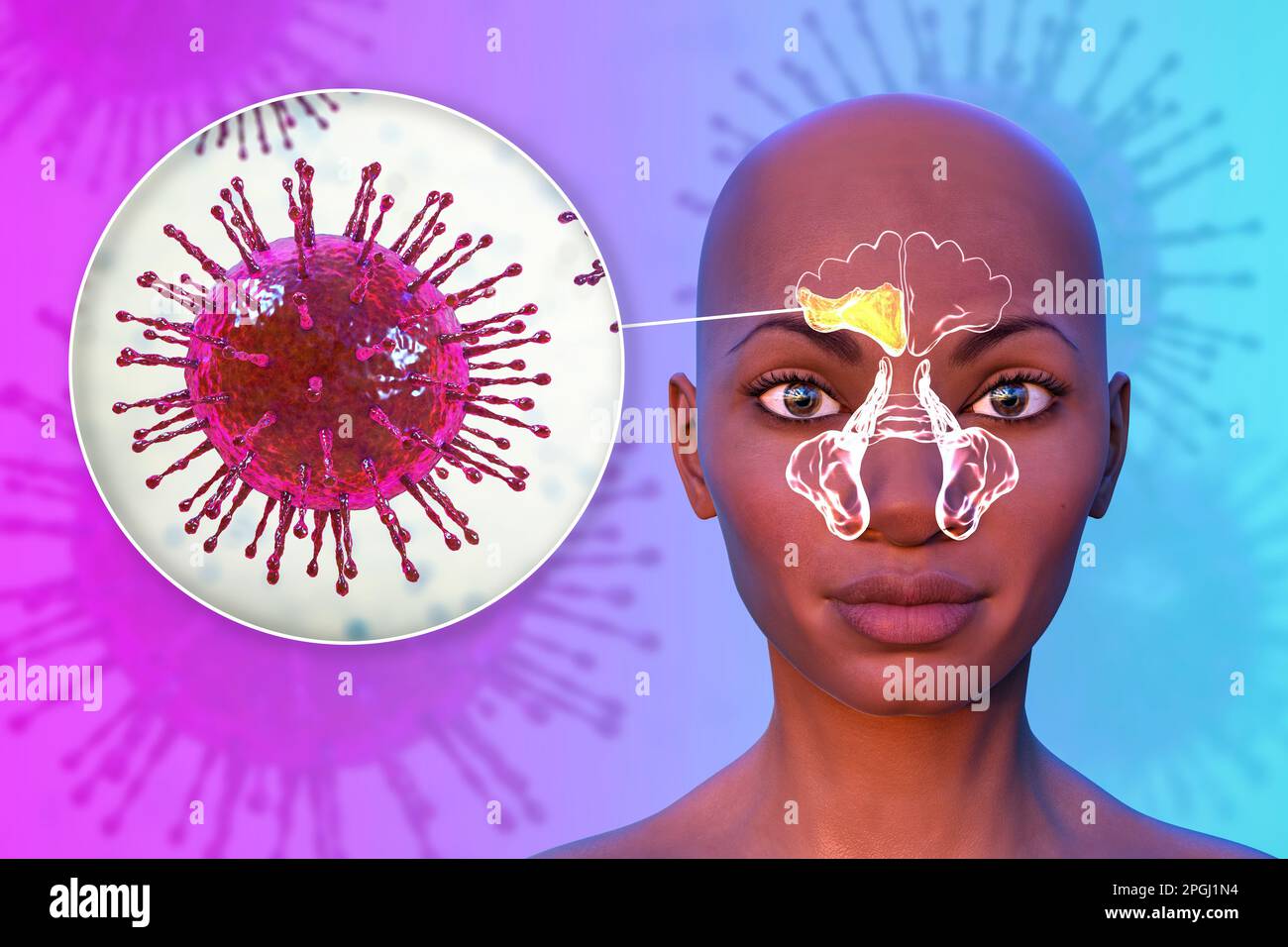 Viral sinusitis, computer illustration. Sinusitis, also known as a