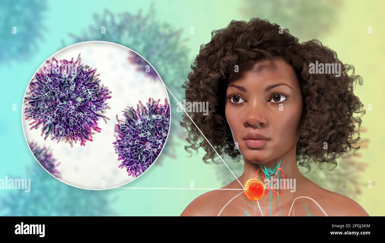 Thyroid gland cancer with closeup view of cancer cells, computer