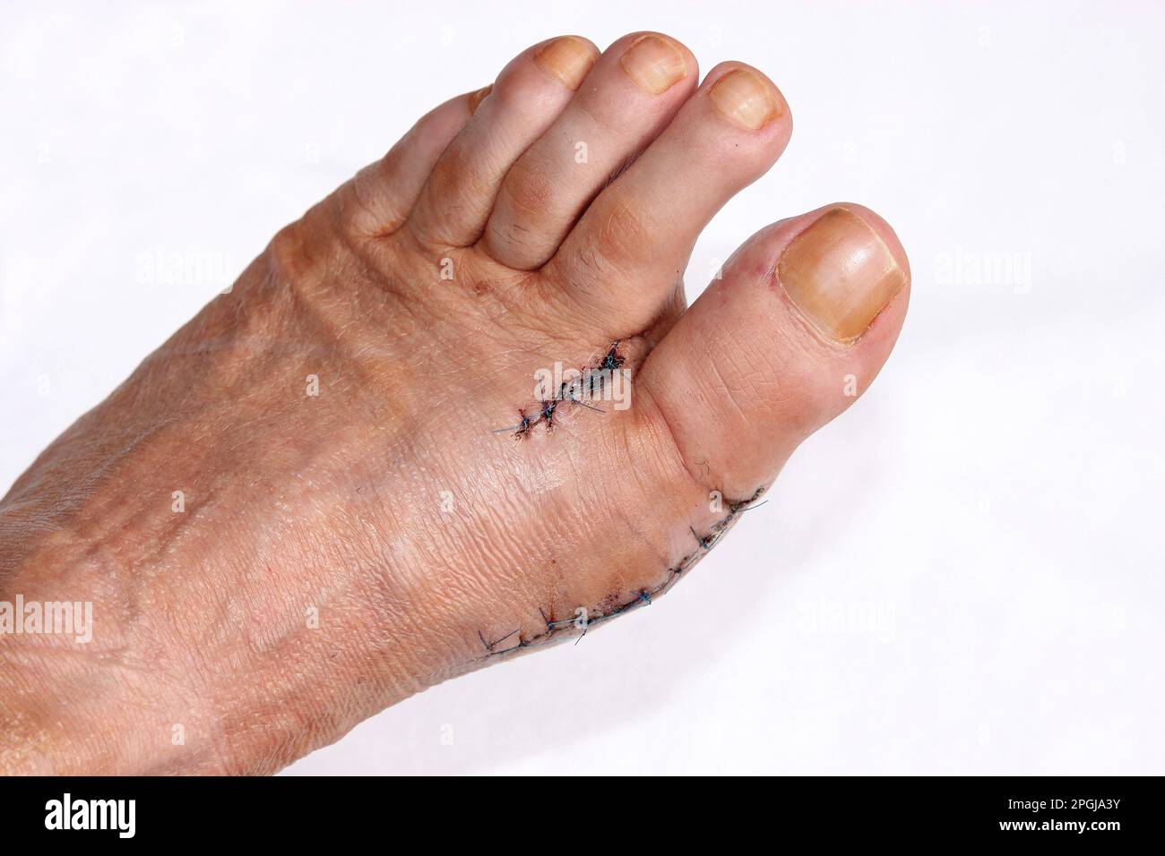 Hallux valgus, foot after surgery Stock Photo
