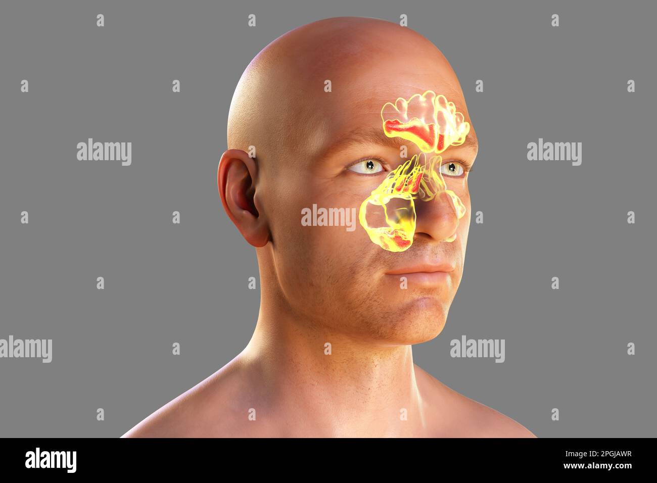 Sinus infection, or sinusitis, computer illustration. The sinuses are
