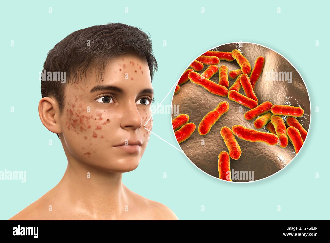 Acne vulgaris on a teenage boy's face and closeup view of bacteria