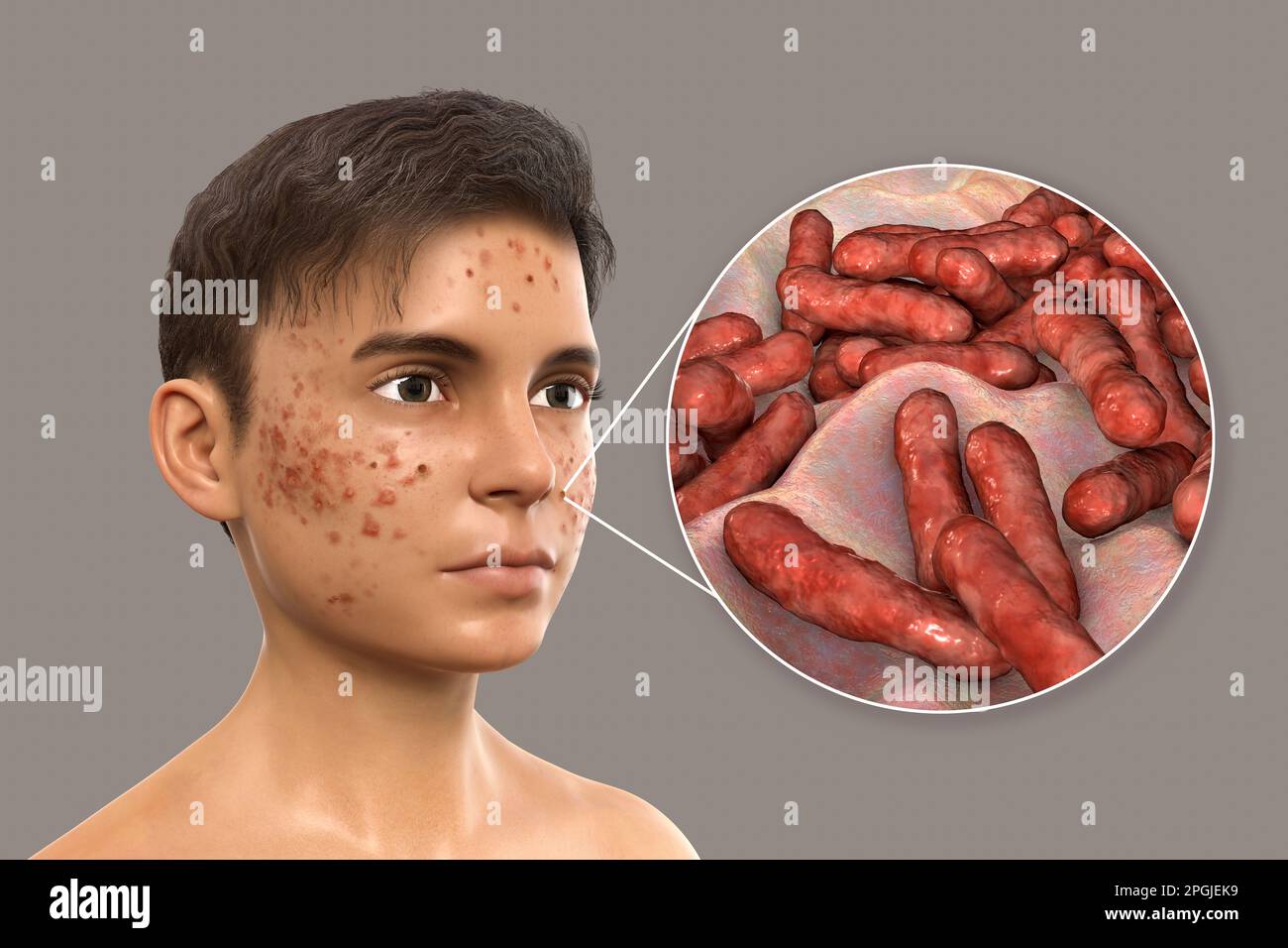 Acne vulgaris on a teenage boy's face and closeup view of bacteria