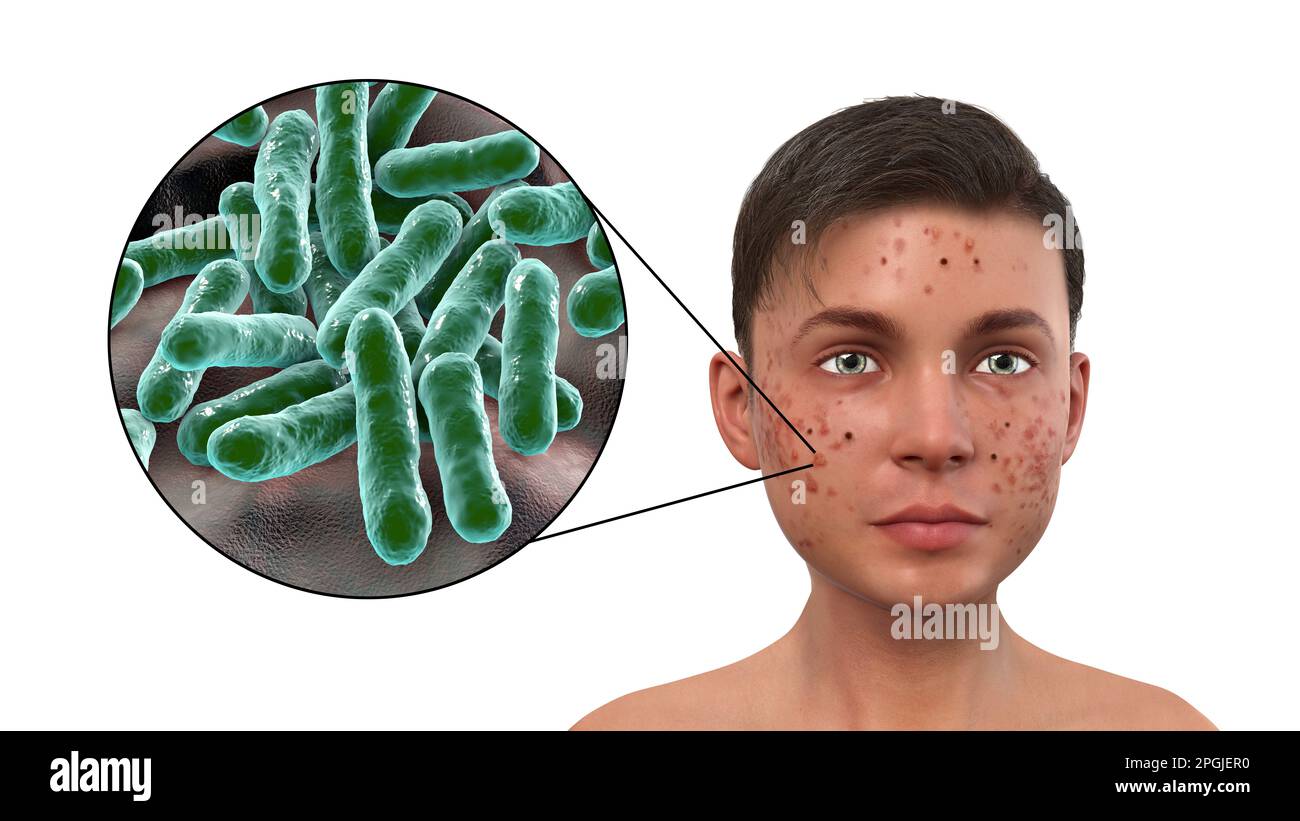 Propionibacterium acne hires stock photography and images Alamy