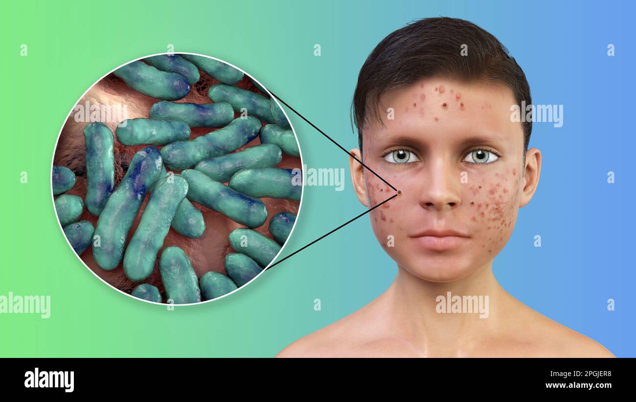 Acne vulgaris on a teenage boy's face and closeup view of bacteria