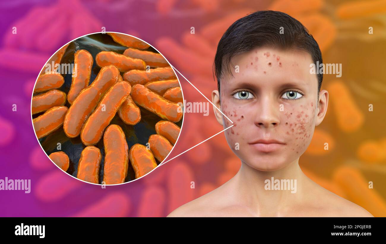 Acne vulgaris on a teenage boy's face and closeup view of bacteria