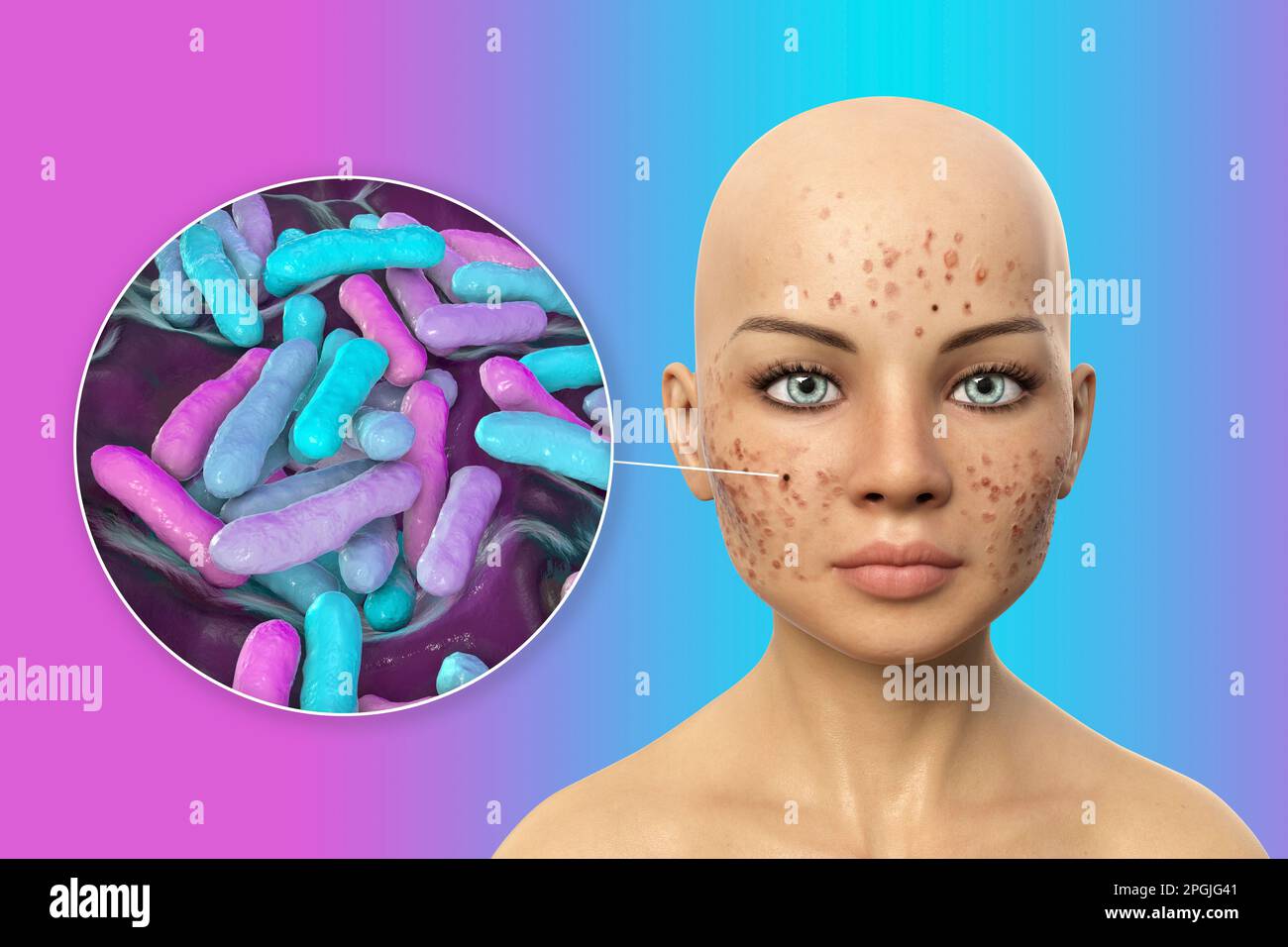 Acne vulgaris on a teenage girl's face and closeup view of bacteria