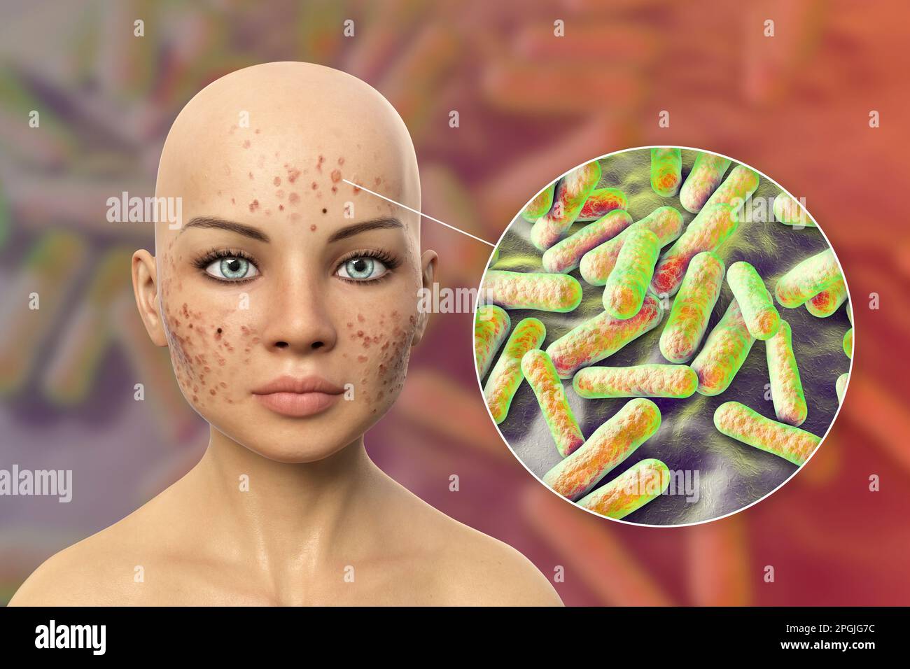 Acne vulgaris on a teenage girl's face and closeup view of bacteria