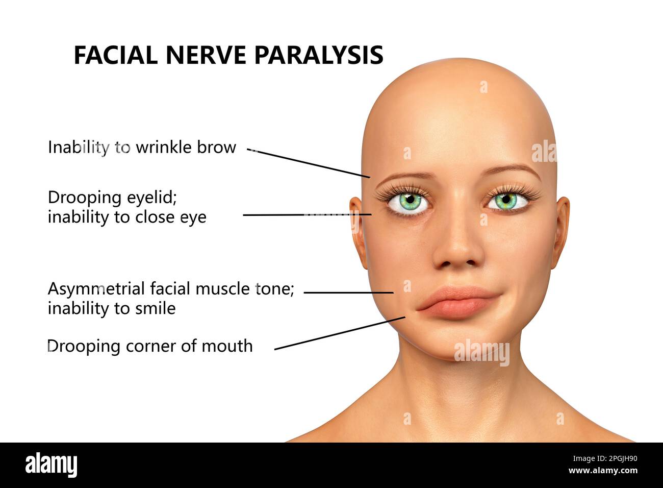 Bell's palsy, a unilateral facial paralysis, computer illustration. The