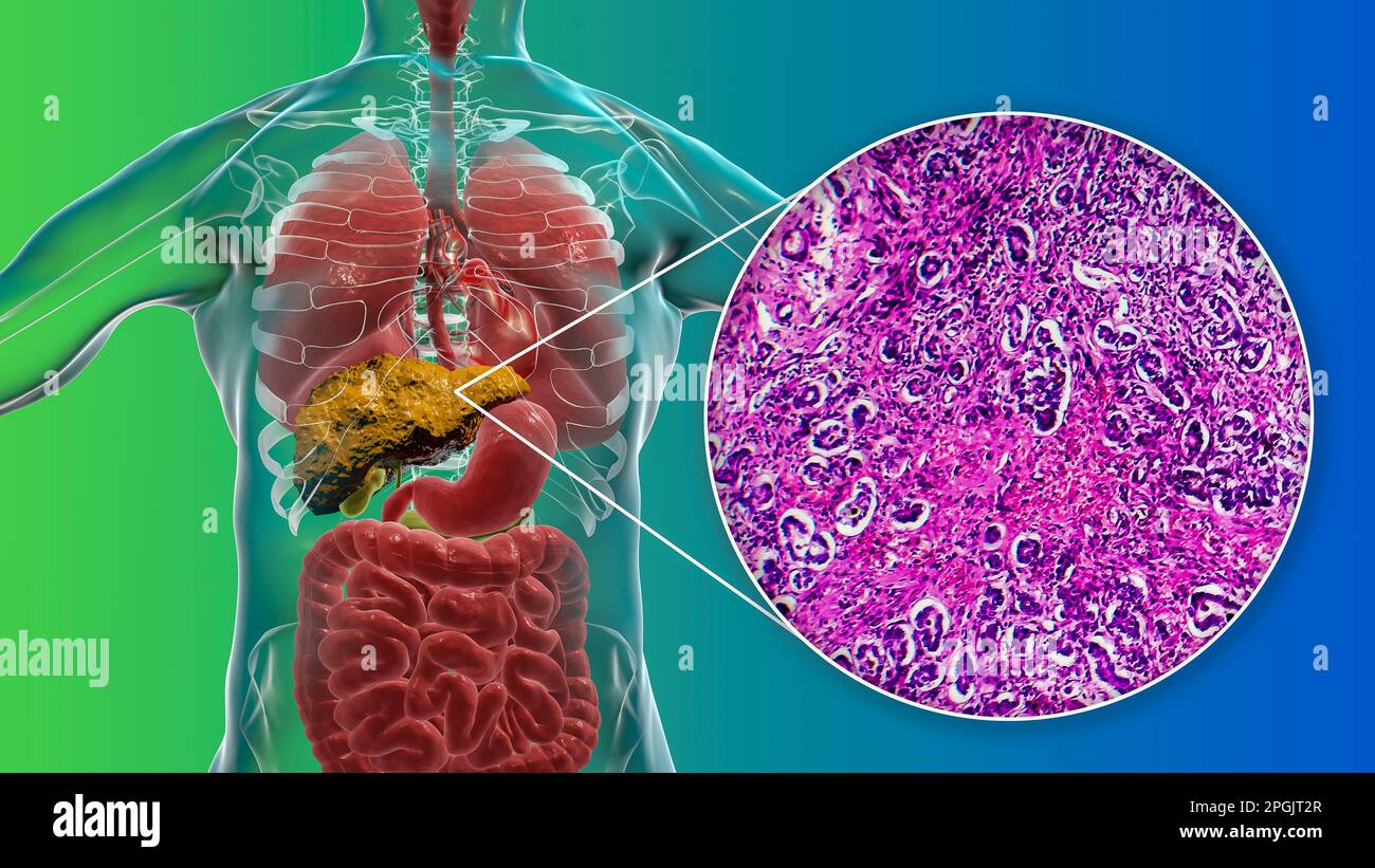 Liver cirrhosis, computer illustration and light micrograph of a