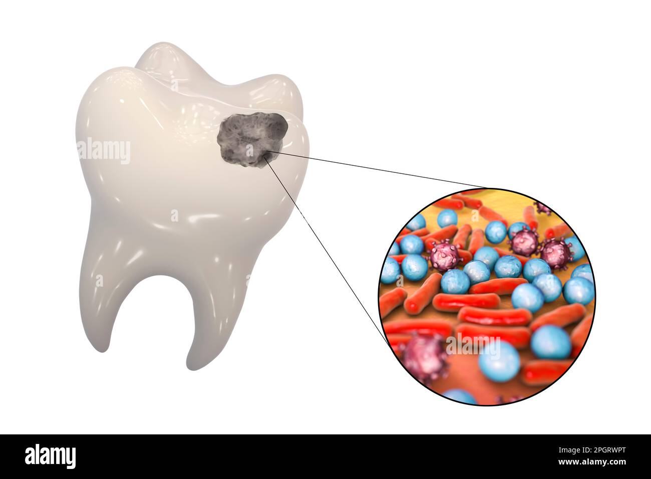 Tooth decay. Computer artwork of a tooth with cavity and closeup view
