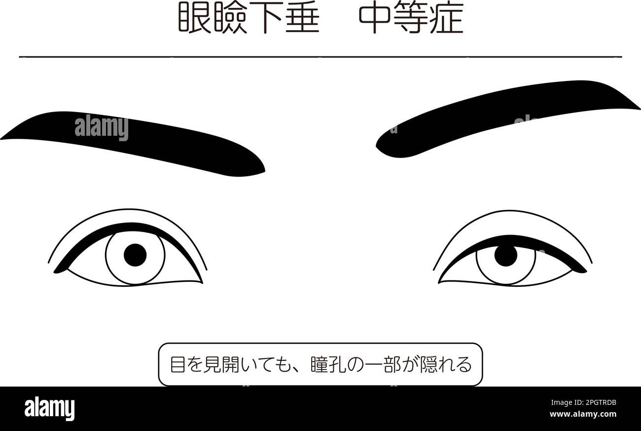 Medical illustration Diagram of moderate ptosis (eyelid drooping
