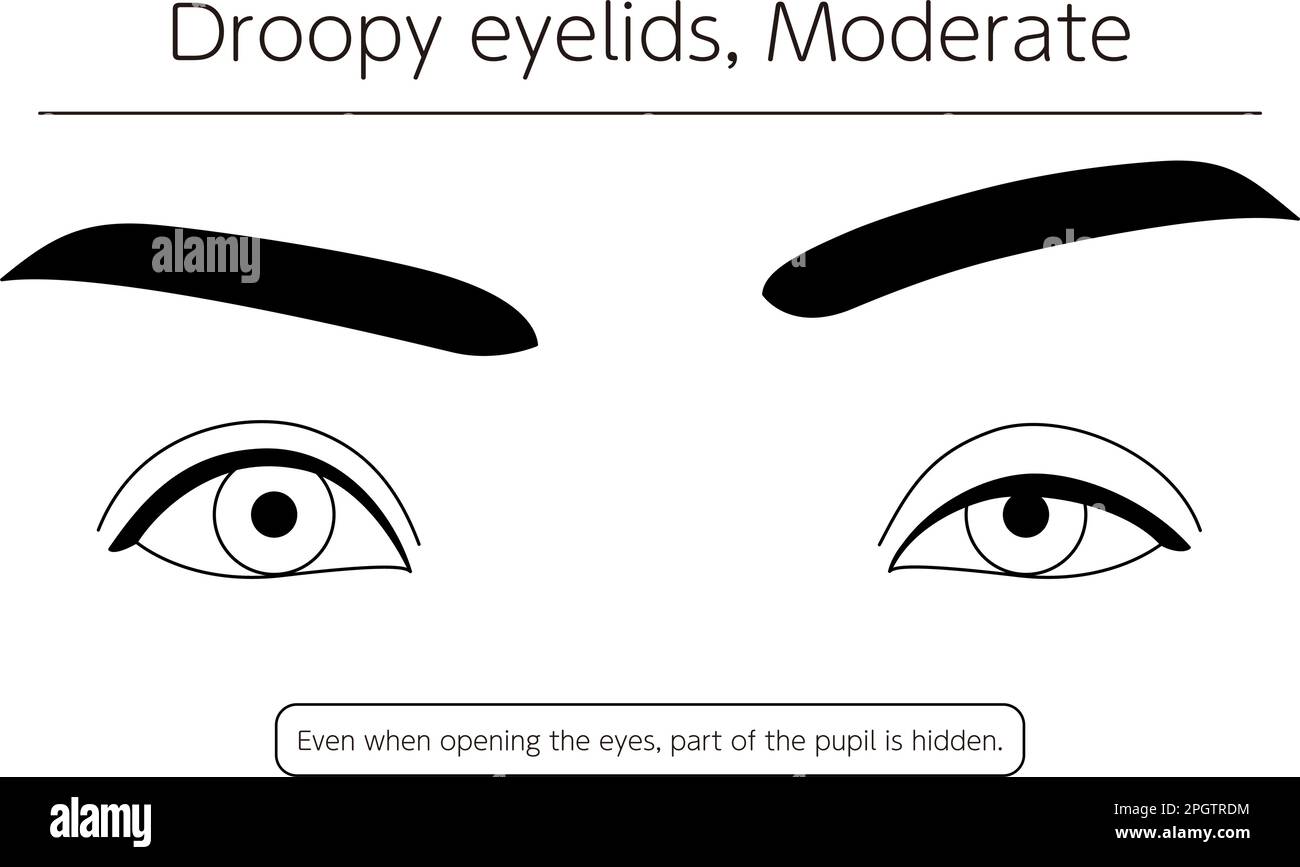 Medical illustration Diagram of moderate ptosis (eyelid drooping