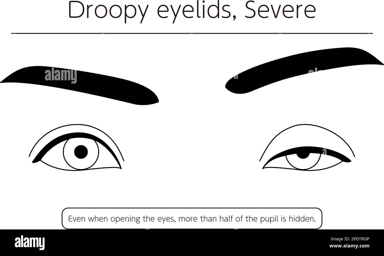 Medical illustration: Diagram of severe ptosis (eyelid drooping), Vector Illustration Stock Vector