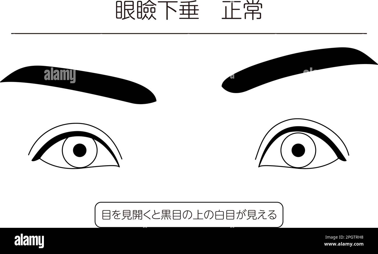 Medical illustration Diagram of normal state of ptosis (eyelid