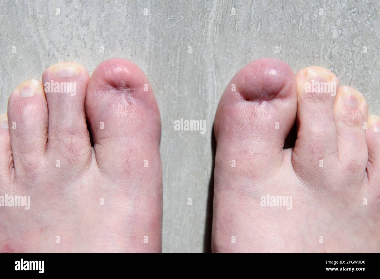 Ingrowing Toenails, Big Toes, Roots cut out Stock Photo Alamy