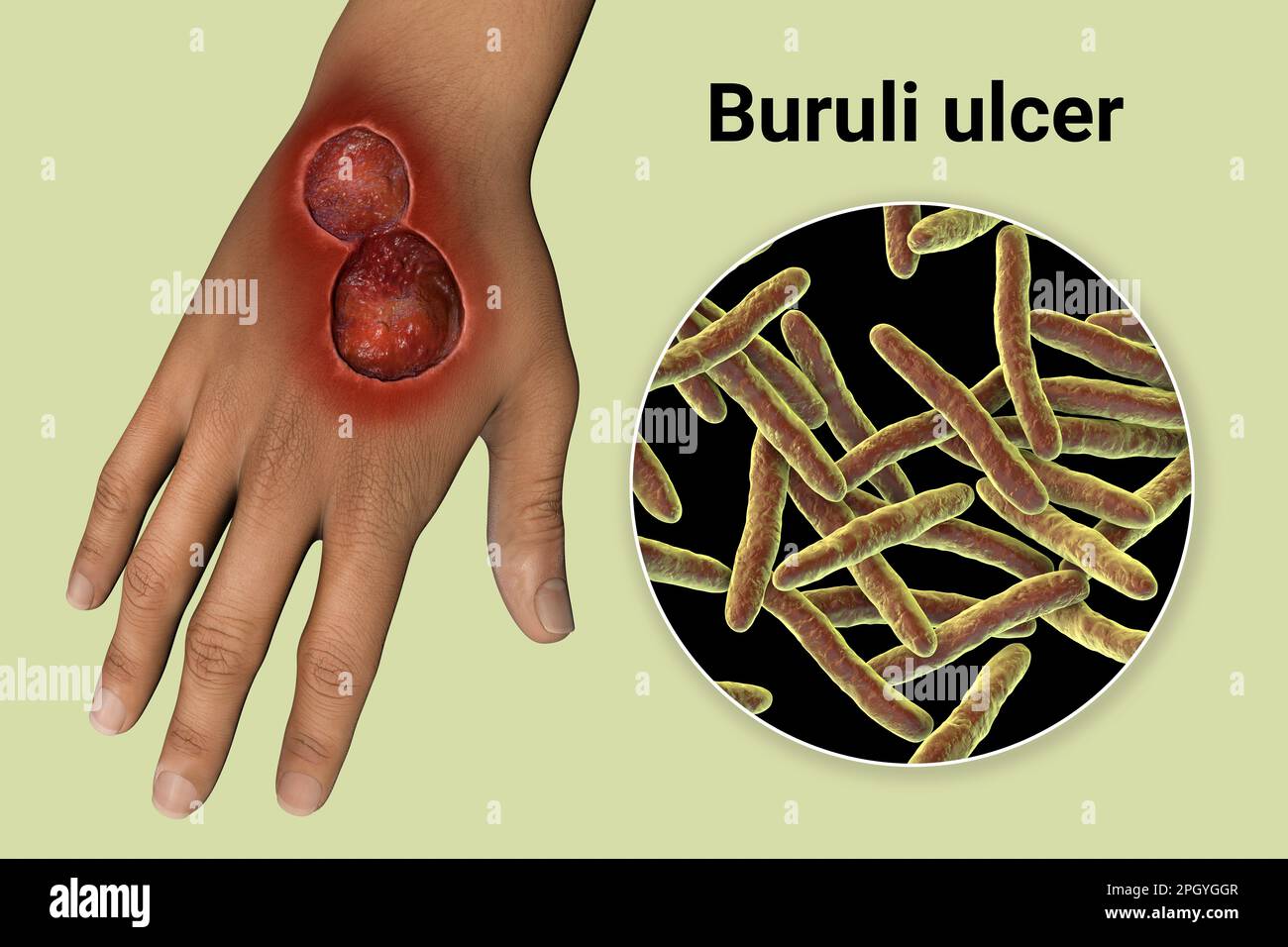 Illustration of a buruli ulcer on a hand with a closeup view of