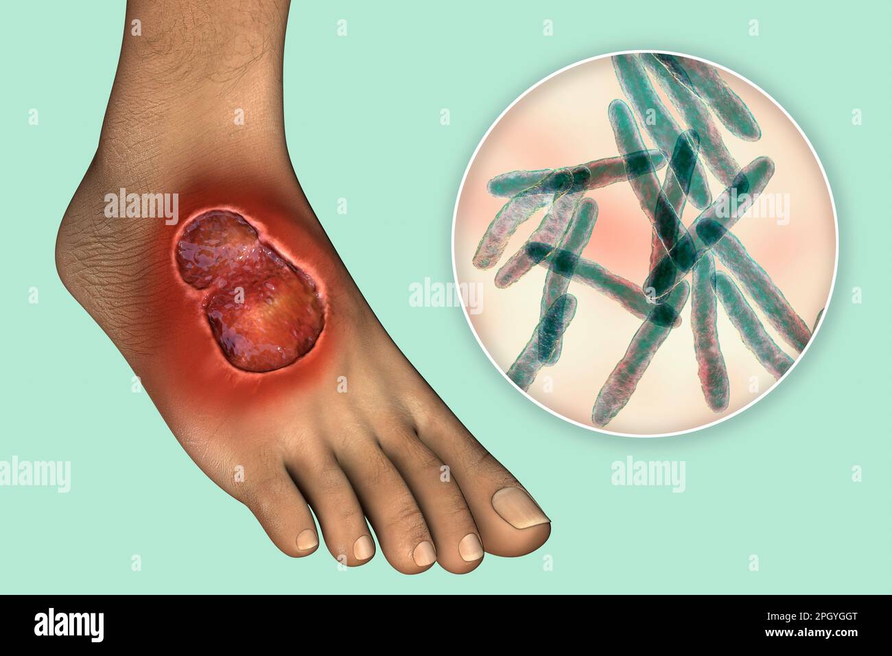 Buruli ulcer and Mycobacterium ulcerans, illustration Stock Photo