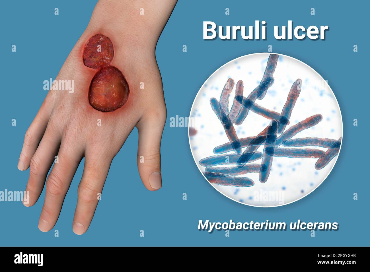 Buruli ulcer and Mycobacterium ulcerans, illustration Stock Photo Alamy