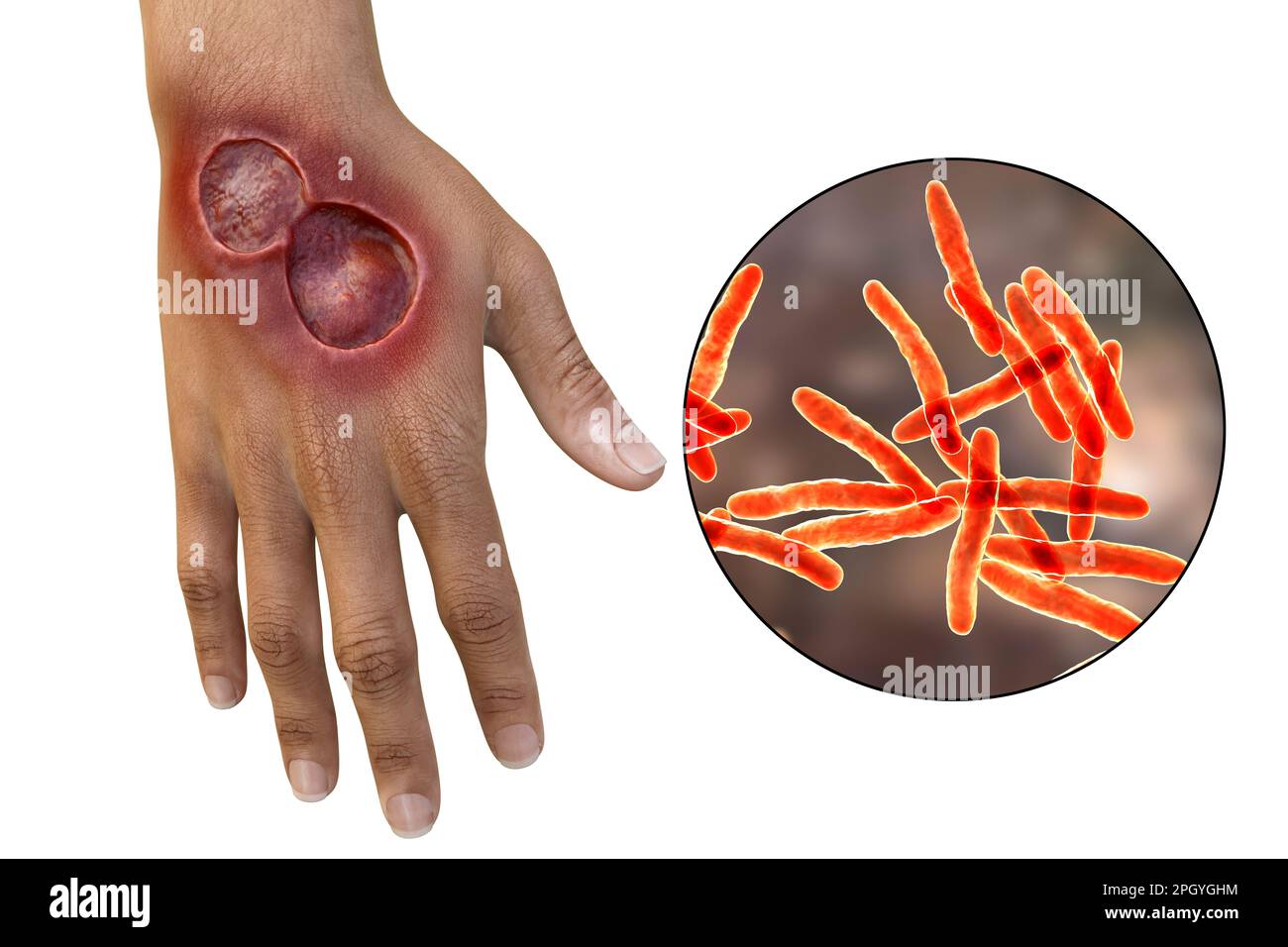 Illustration of a buruli ulcer on a hand with a closeup view of