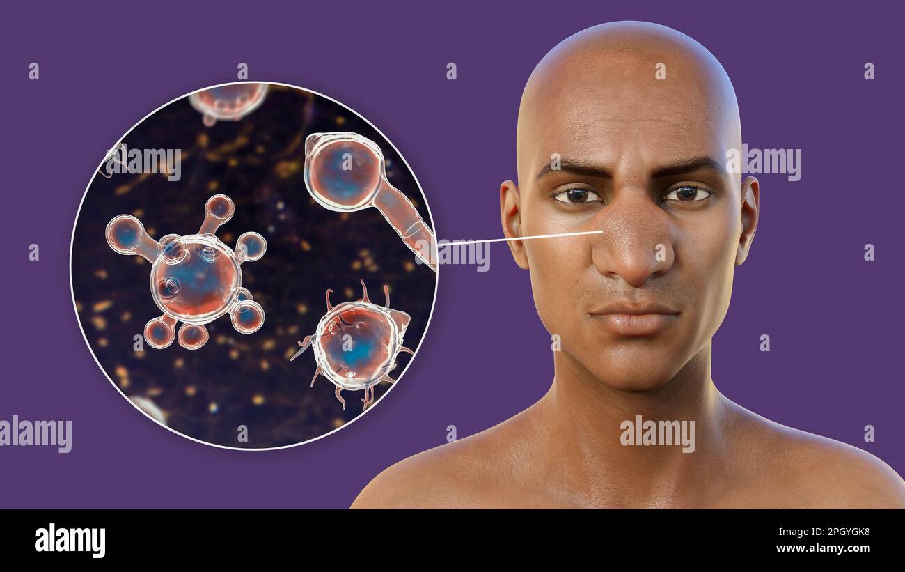 Rhinofacial conidiobolomycosis and fungus, illustration Stock Photo Alamy