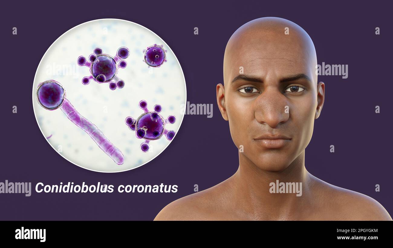 Rhinofacial conidiobolomycosis and fungus, illustration Stock Photo Alamy
