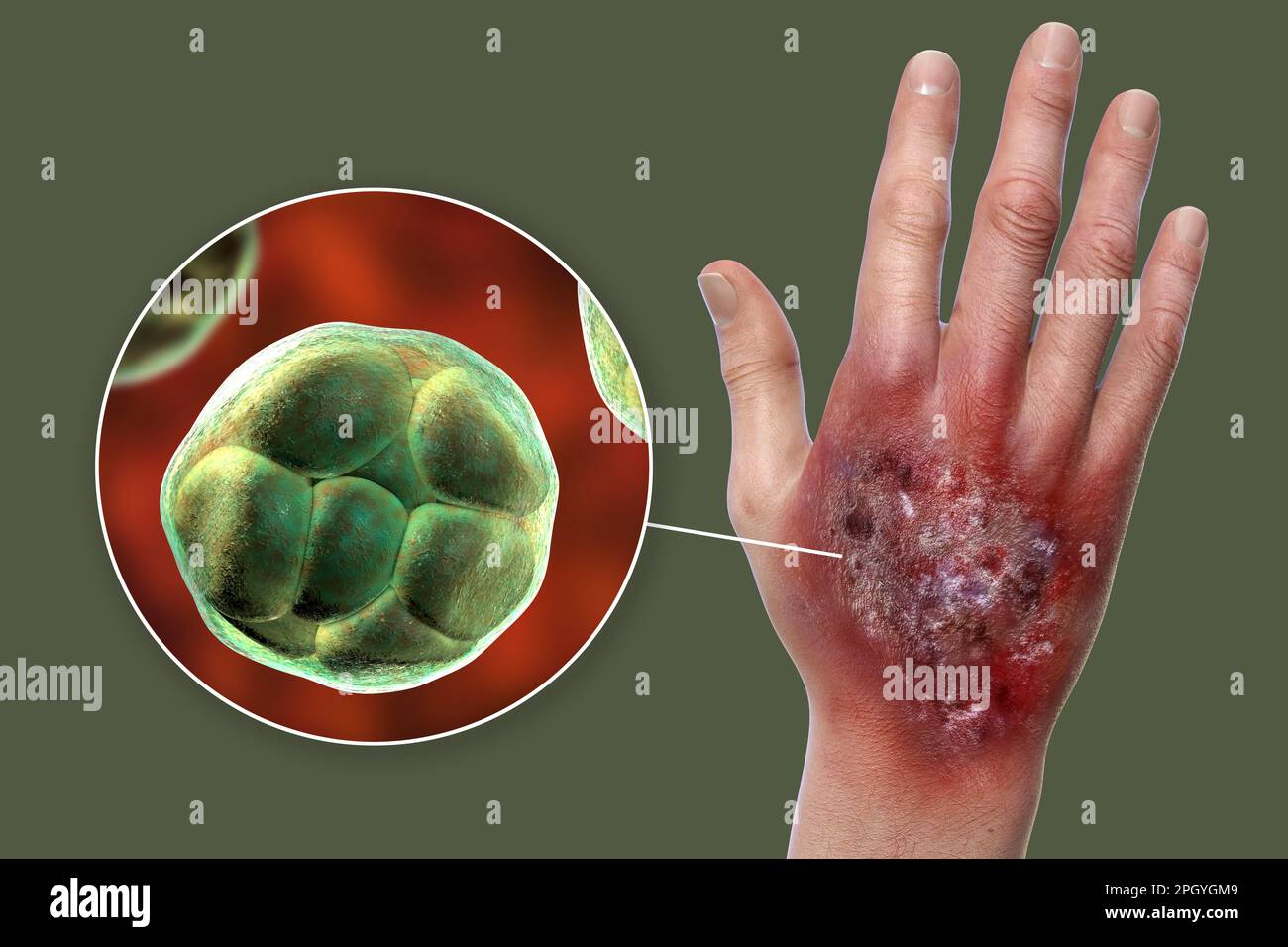 Protothecosis infection on a human hand, illustration Stock Photo - Alamy