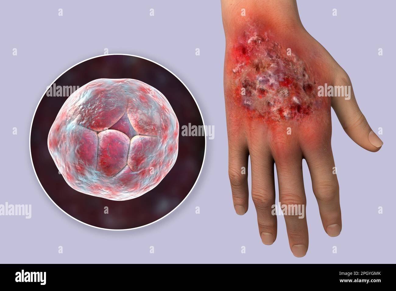 Protothecosis infection on a human hand, illustration Stock Photo