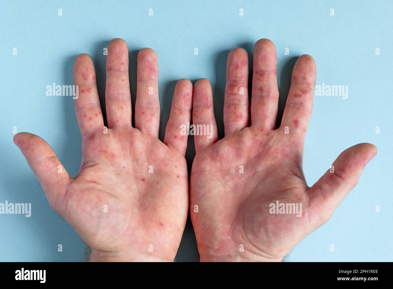 Allergy Rash Hands