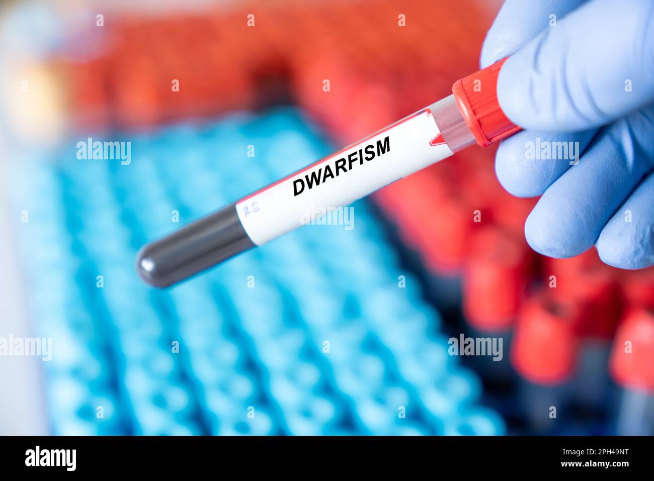 Dwarfism. Dwarfism disease blood test in doctor hand Stock Photo