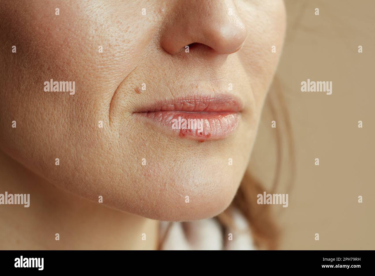 Closeup on woman with herpes on lips against beige background. Stock Photo