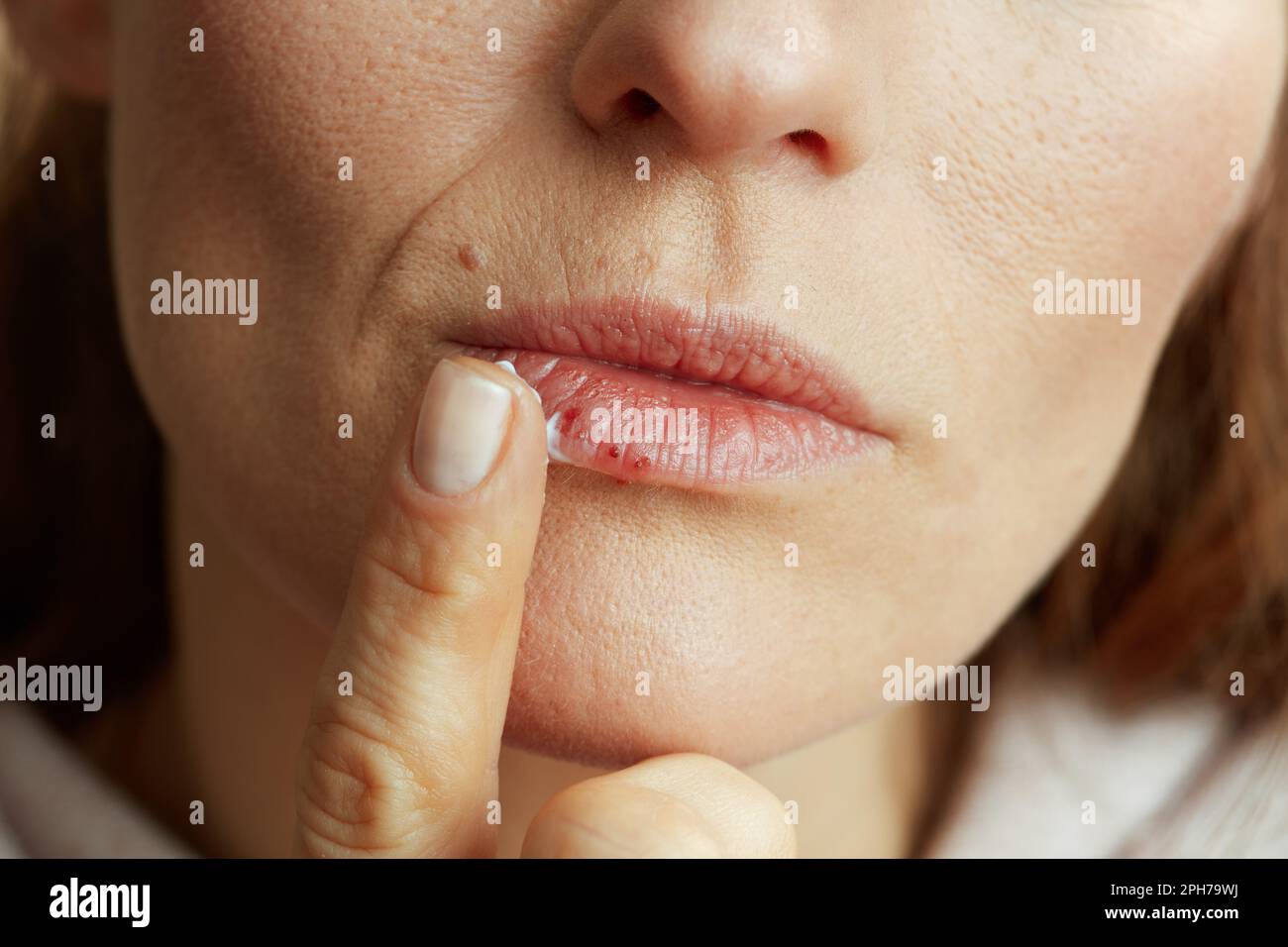 Closeup on female with herpes on lips applying ointment using finger on beige background. Stock Photo