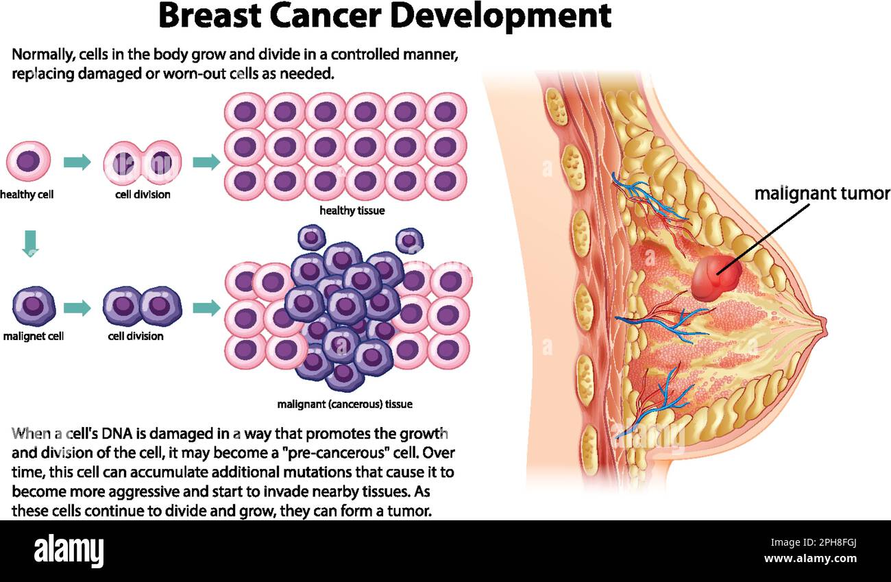 Cancer Development vector with information illustration Stock Vector Image  \u0026 Art - Alamy, image size:1300x849
