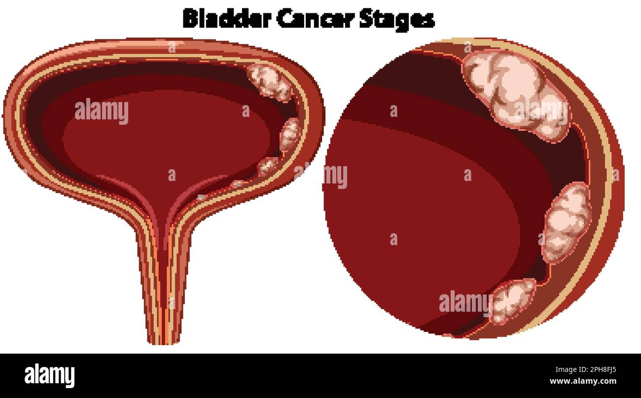 Bladder Cancer Stages Vector illustration Stock Vector