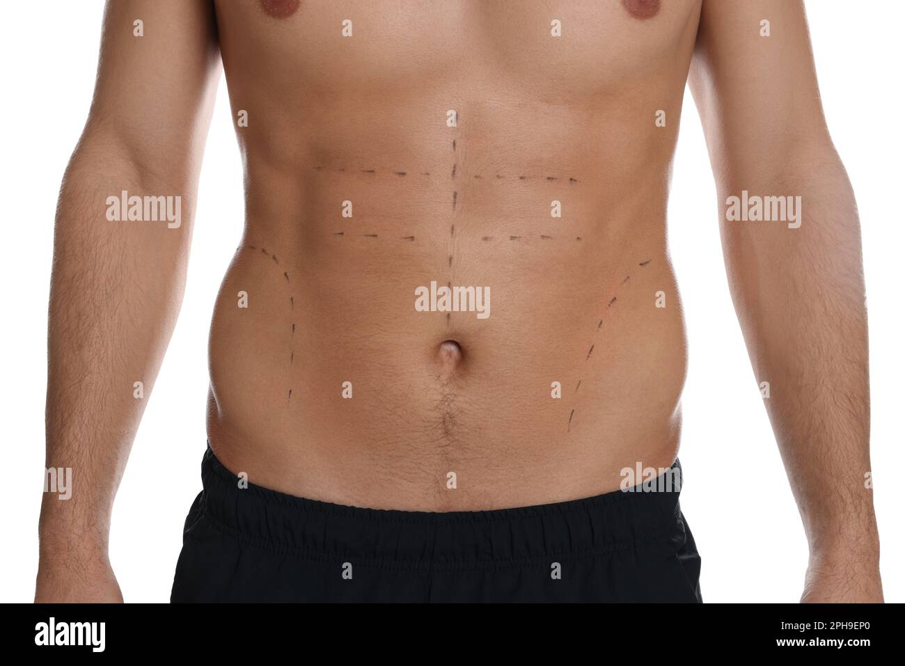 Fit man with marks on body against white background, closeup. Weight loss surgery Stock Photo
