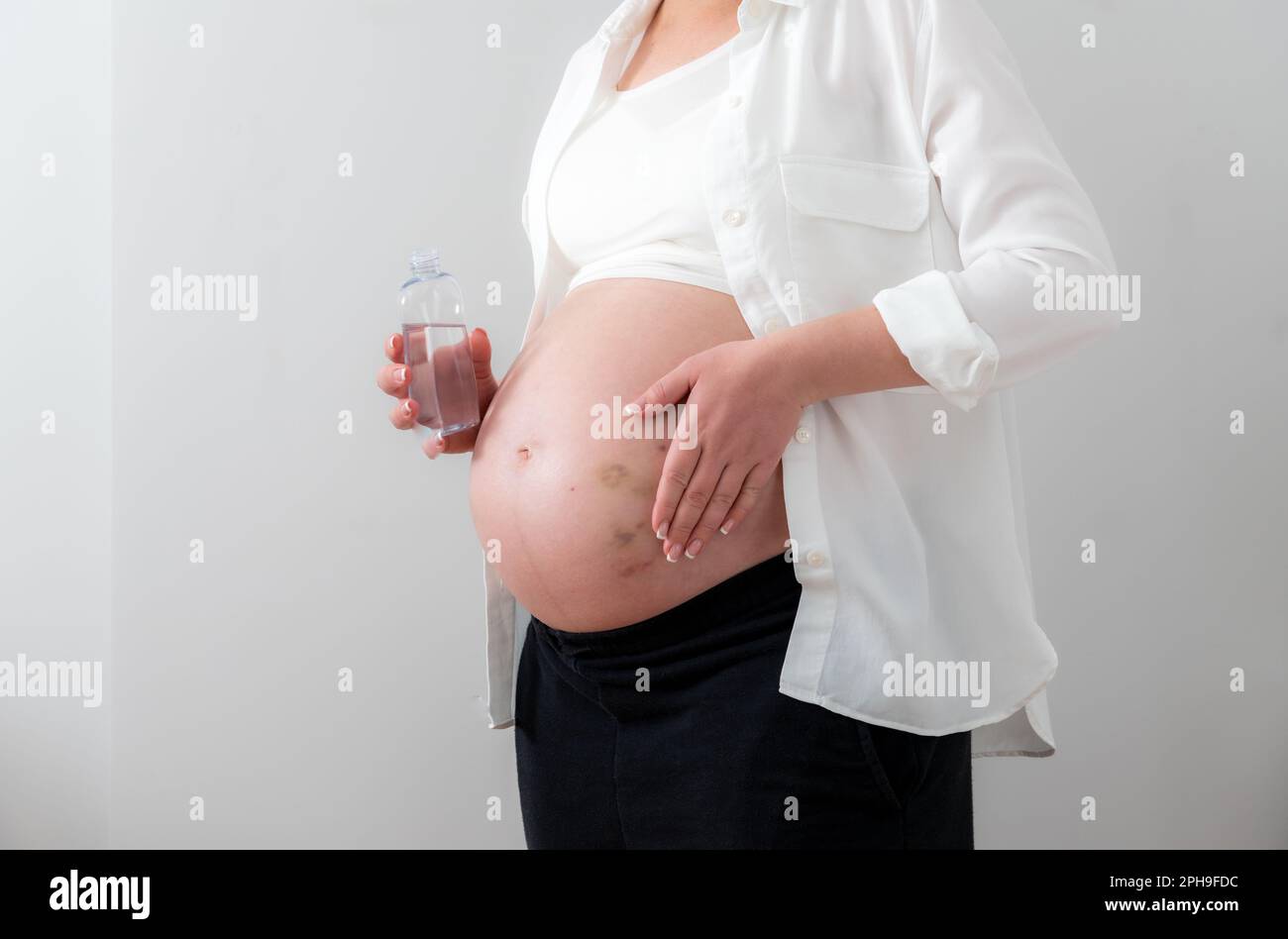 Pregnant woman applying cosmetic oil on her belly for healing puncture