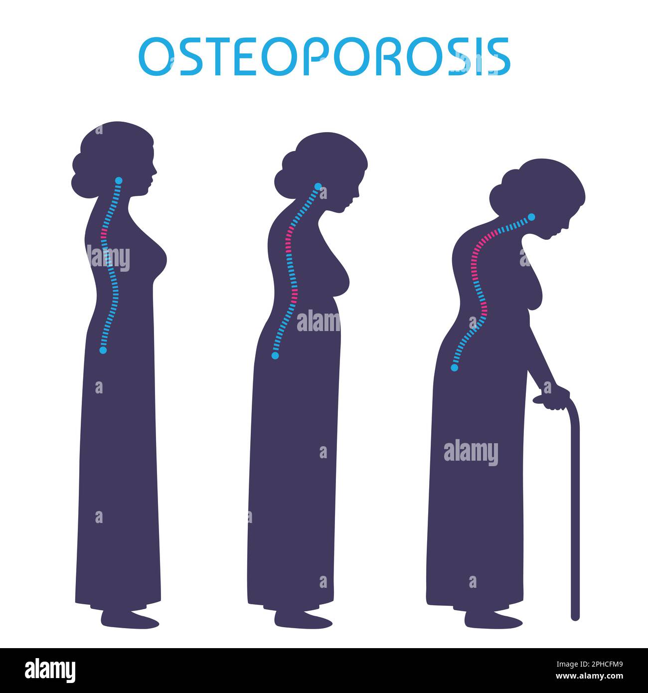 illustration of final stage of osteoporosis, joint pain medical vector