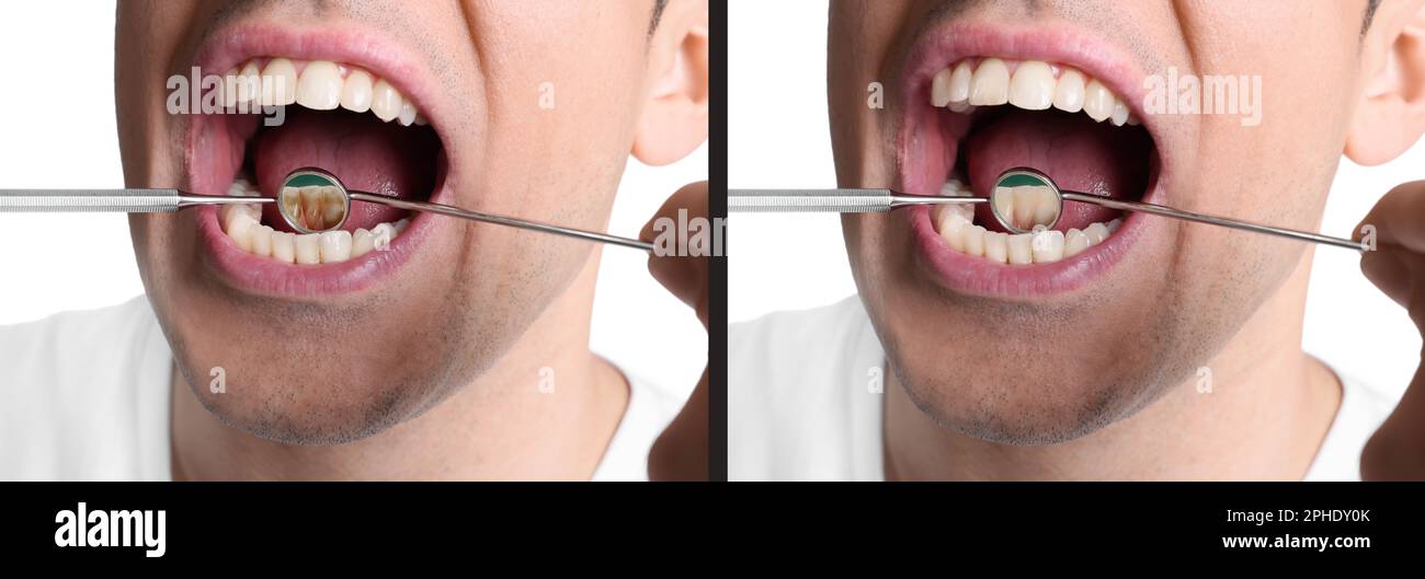 Collage with photos of man before and after professional treatment of ...