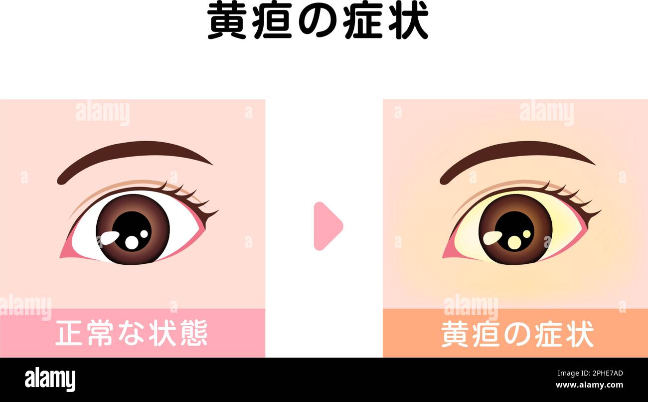 Comparison illustration of normal and jaundiced eyes Stock Vector Image