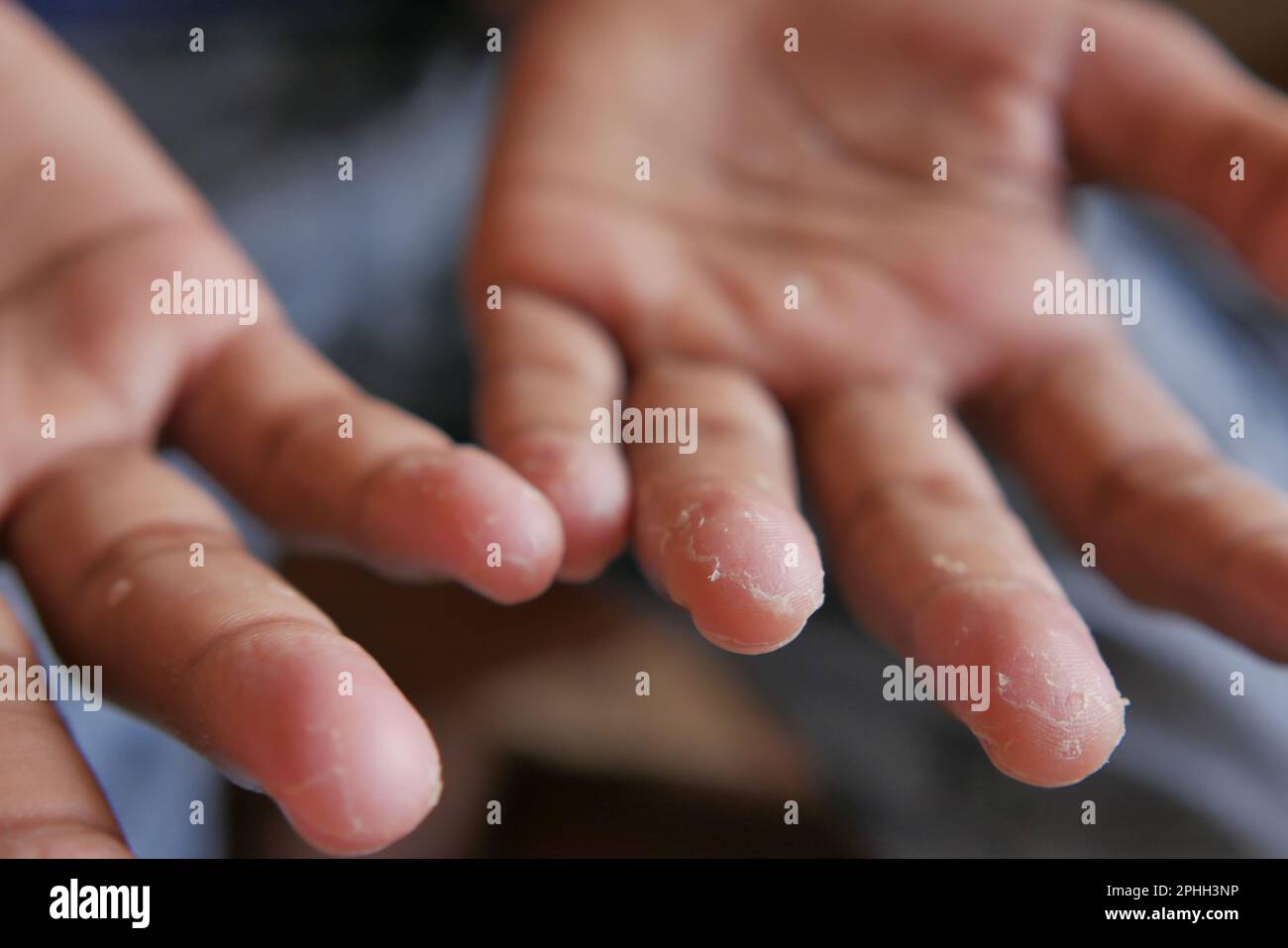 close up of Dry cracked skin of a men's hand  Stock Photo