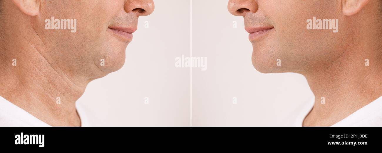 A close portrait of an aged man before and after facial rejuvenation procedure. Correction of the chin shape liposuction of the neck. The result of th Stock Photo