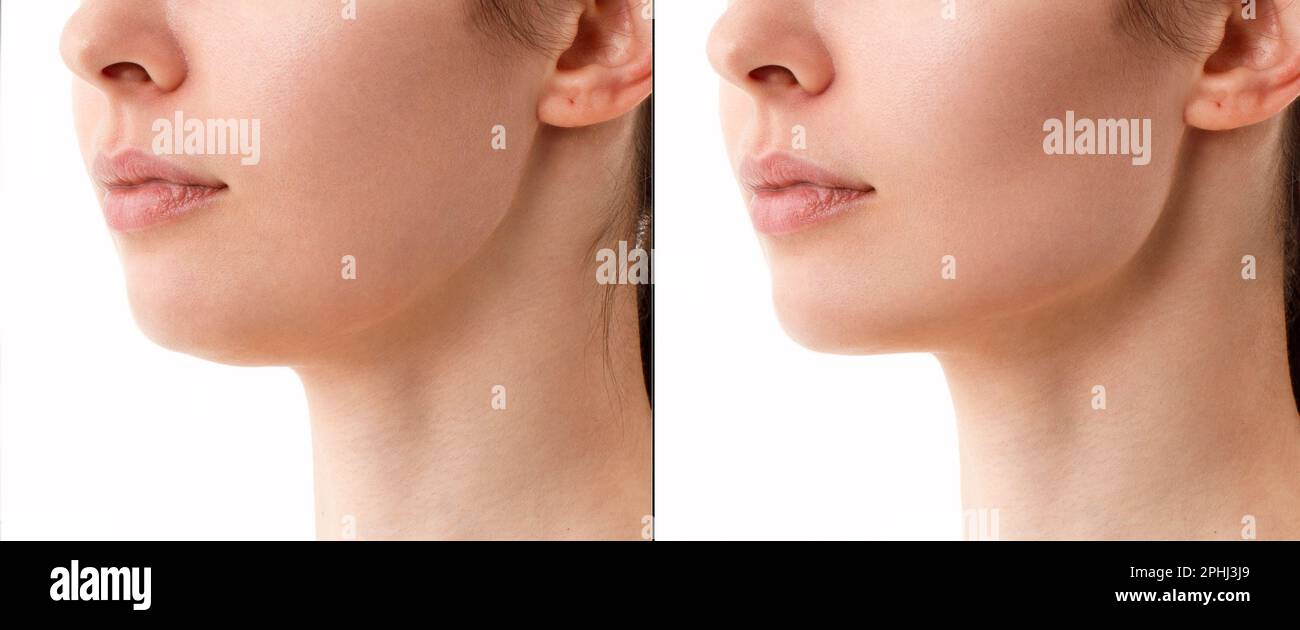 Close-up portrait of a woman before and after a chin correction procedure with neck liposuction. Fillers on the cheekbones and chin. The result of the Stock Photo
