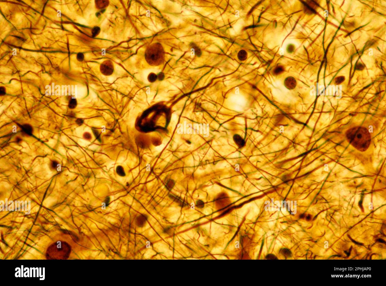 Neurofibrillary tangles in pyramidal neuron, light micrograph Stock Photo