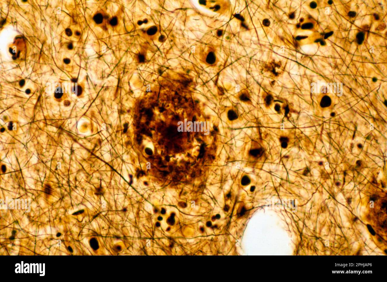 Senile plaque in cerebral cortex, light micrograph Stock Photo Alamy