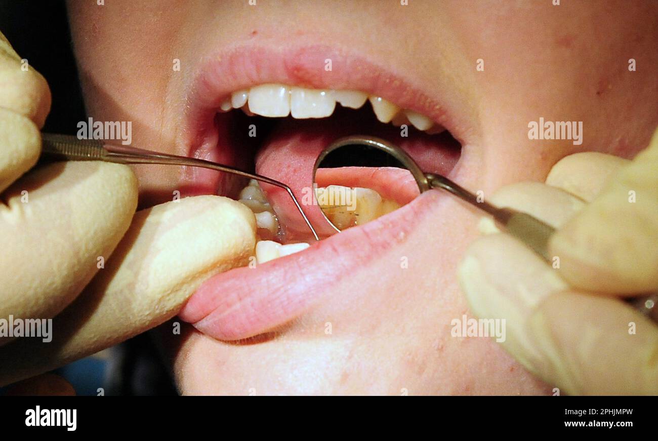 File photo dated 19/05/11 of a general view of a dentist at work, as Bupa Dental Care is set to cut 85 dental practices in a move that will affect 1,200 staff across the UK, amid a national shortage of dentists and 'systemic' challenges across the industry. Stock Photo