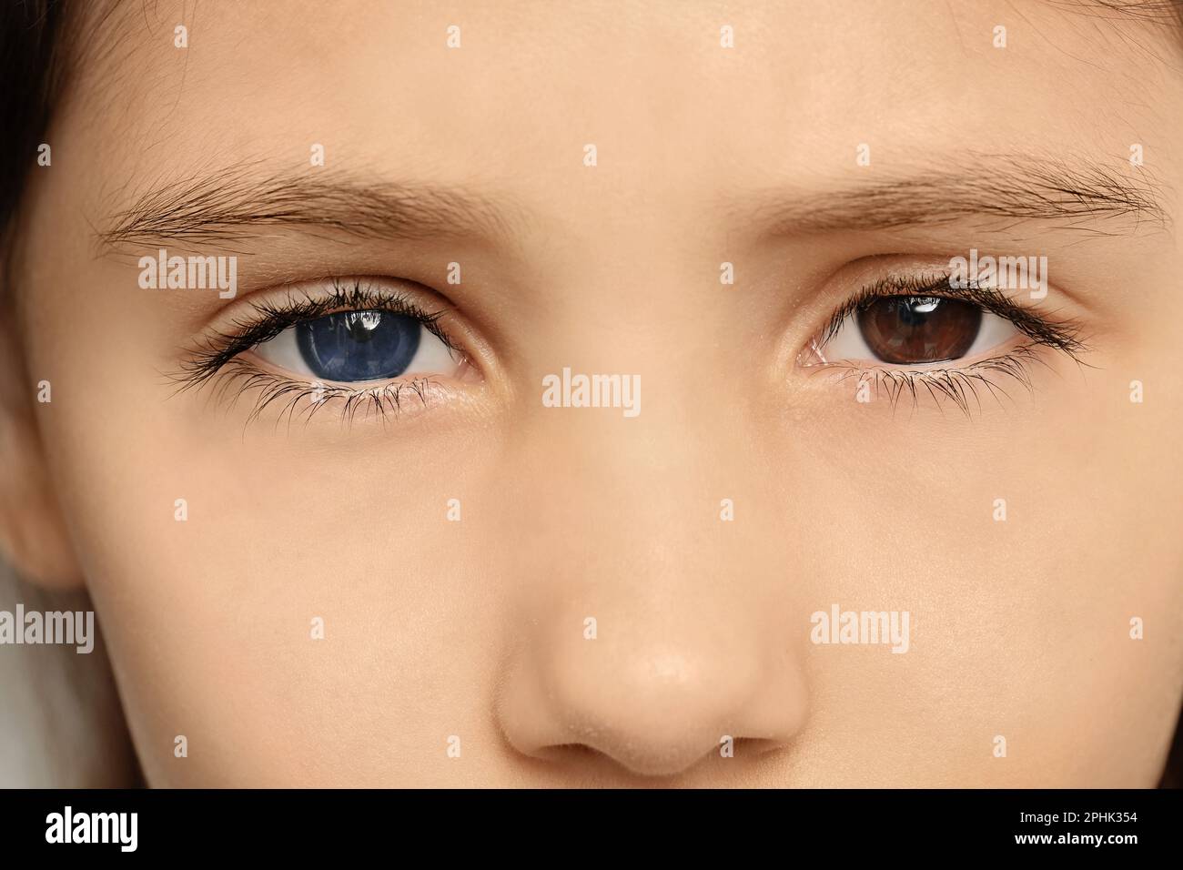 Little girl with different colors of eyes, closeup. Heterochromia iridis Stock Photo