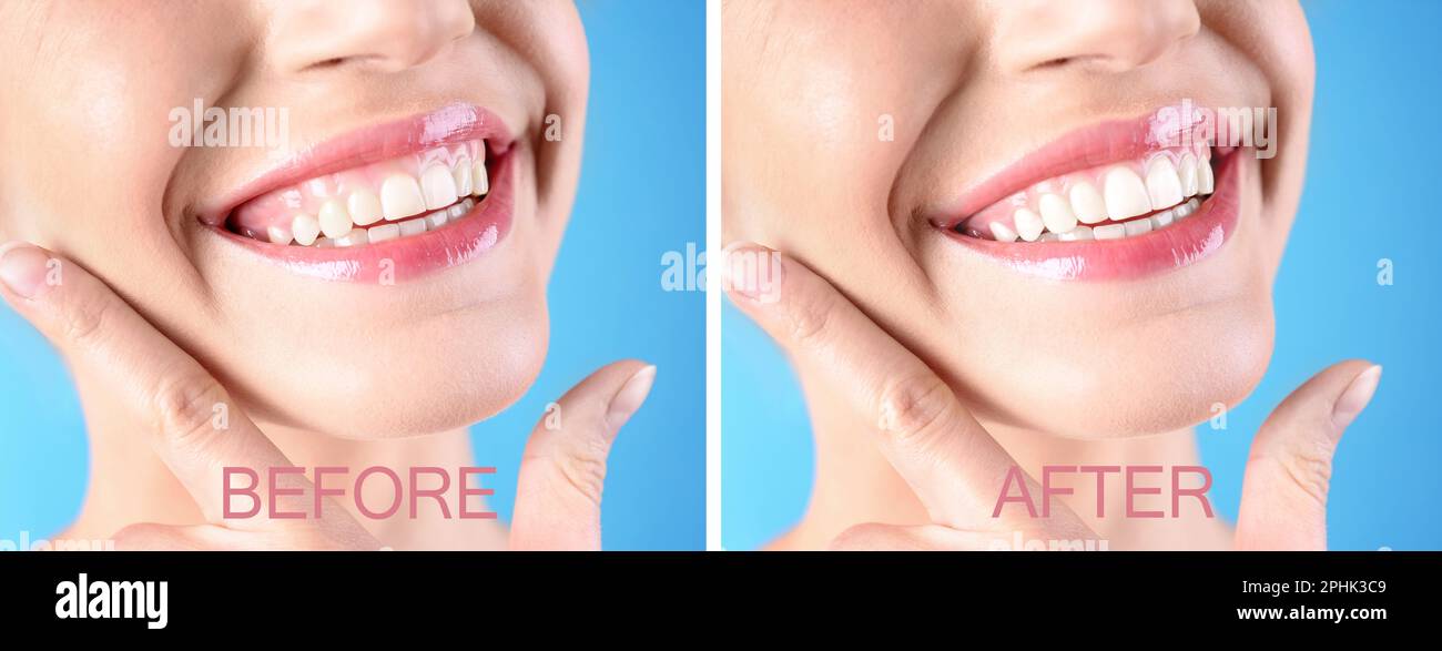 Laser tooth whitening hi res stock photography and images Page 7